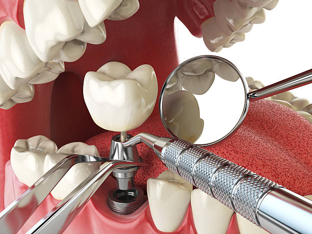 Best Emergency Root Canal Treatment in Independence, IA